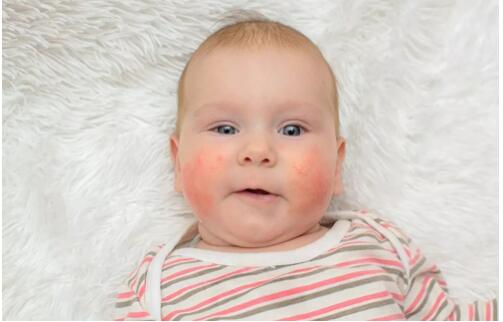 婴儿护理湿疹的六大细节，家长别大意！