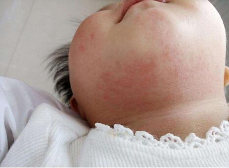 新生儿湿疹与热疹如何预防和处理，爸爸妈妈需牢记